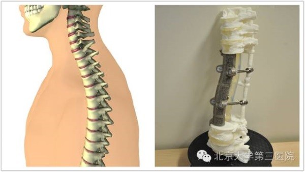 世界首个3D打印定制人工椎体植入术