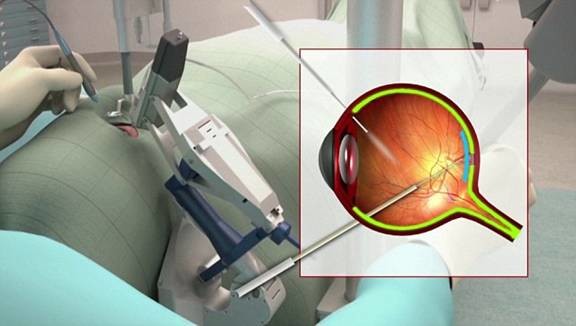 世界首例借助医疗机器人成功恢复患者视觉