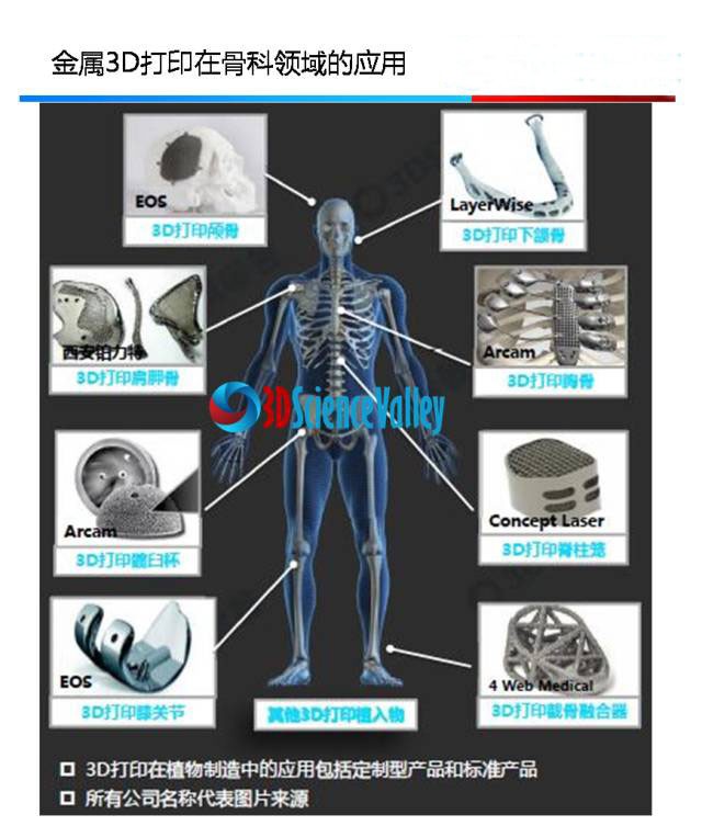 后路腰椎间融合器——Stryker的产业化之路