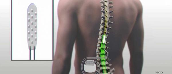 电子脊椎可让截瘫病人重新活动双腿