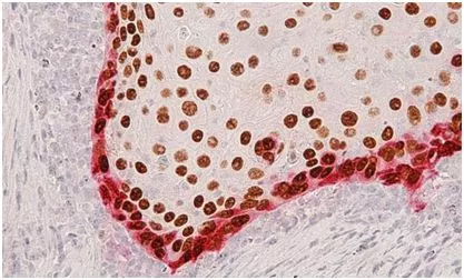 Cell：重磅！首次构建出人头颈癌的完整细胞图谱