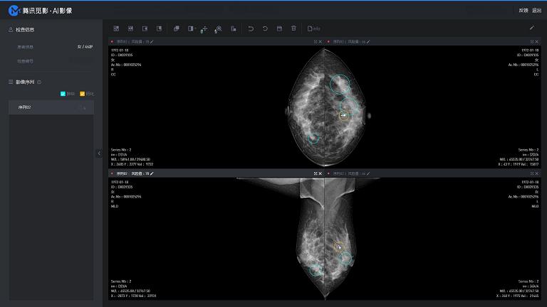 “中國(guó)式”乳腺癌高發(fā)期提前了10年，AI能否成為解決的助力？