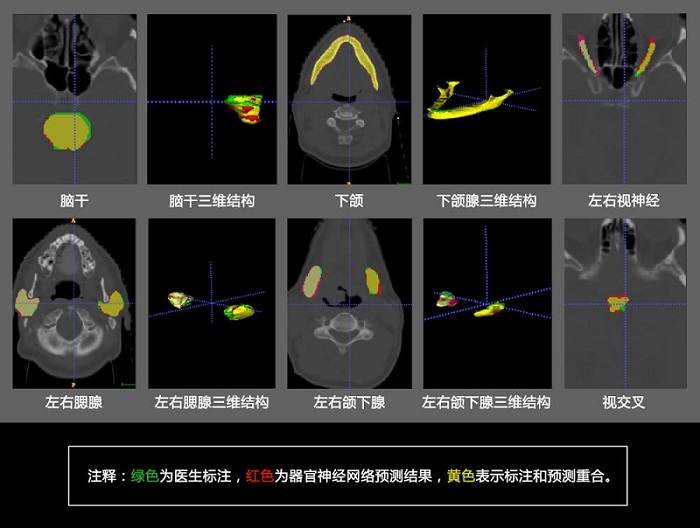 腾讯医疗AI最新研究成果，用深度学习分割头颈组织区域助力靶向治疗