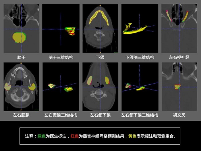 騰訊醫(yī)療AI最新研究成果，用深度學(xué)習(xí)分割頭頸組織區(qū)域助力靶向治療