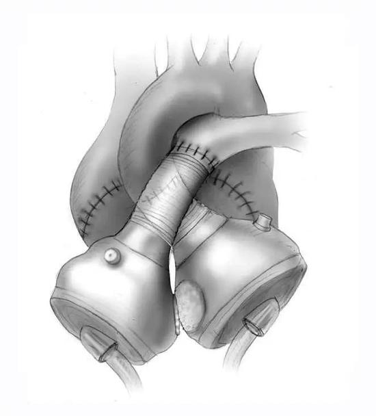 人工心脏示意图