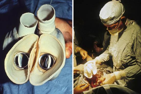 人工心脏手术50周年纪念时发布的老照片