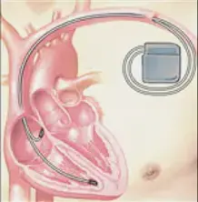 细数心脏起搏器和ICD之间的差异