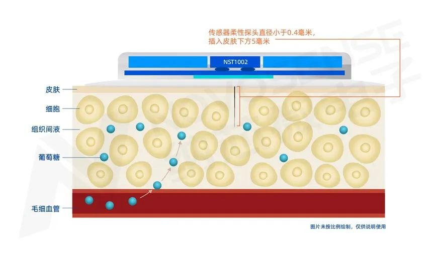 监测血糖黑科技，纳芯微NST1002助力CGM精准测量