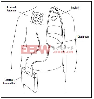 图7,呼吸起搏器带有用于膈神经刺激的植入电极以及RF接收器，还有向植入体发射RF信号的外部天线，完成刺激起搏功能